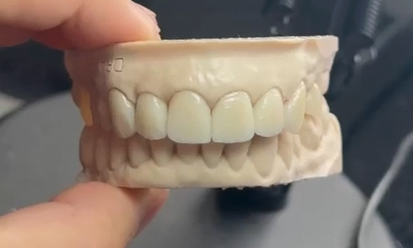 Carillas de porcelana de la Dra. Alejandra Hernández en Bogotá